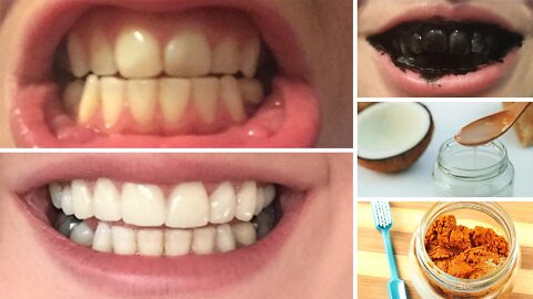 DIY 10 Home Remedies To Whiten Teeth