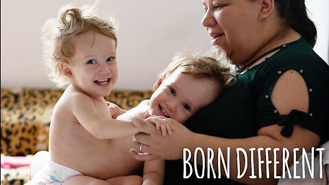 The Twin Sisters Who Share A Body | BORN DIFFERENT