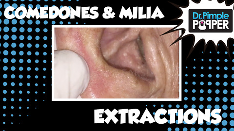 Blackheads on the Back & Milia in the Ears!