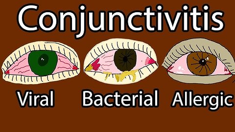 Pink Eye Infection | Conjunctivitis| Prevention Treatment | Animation | 2023 | AIM Pharma