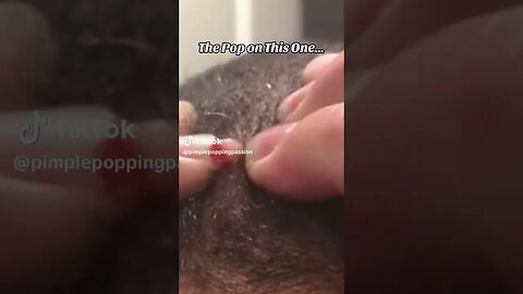 THE POP ON THIS ONE!!! #pimplepoppingvideos #pimplepopping #pimplesremoval #pimpleproblem