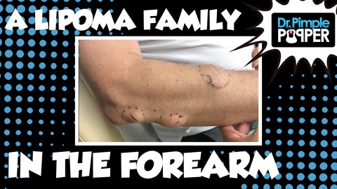 A Family of Lipomas in ONE forearm!