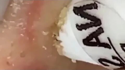 😱best cyst popping compilation 2023 satisfying 😱