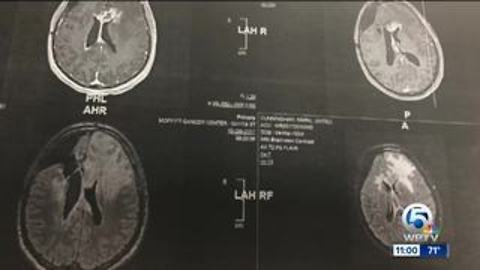 Number of local glioblastoma cases in SLC continues to rise, nearly triples from original count