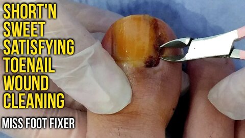 Short'n Sweet Satisfying Toenail wound Cleaning By Foot Doctor Miss Foot Fixer