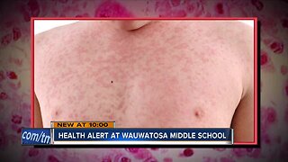 Wauwatosa health officials investigating suspected case of chicken pox at Longfellow Middle School