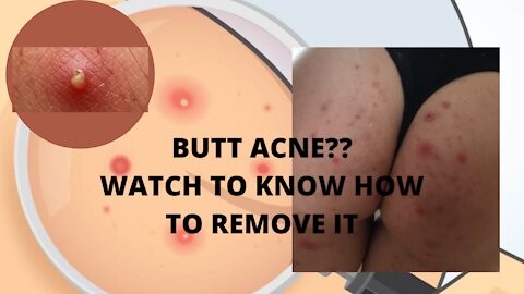 LEARN HOW TO DO BUTT FACIAL ( Getting Rid of Booty Acne, Scars, and Irritation!)