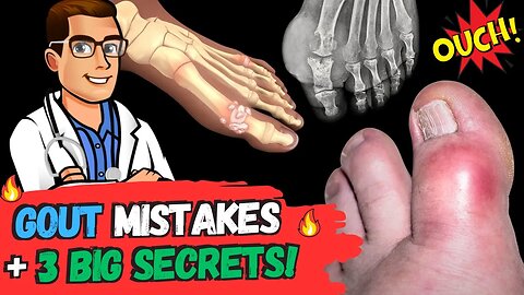The 🔥Gout MISTAKES & 3 BIG Secrets!🔥 [Symptoms, Diet & Treatment]
