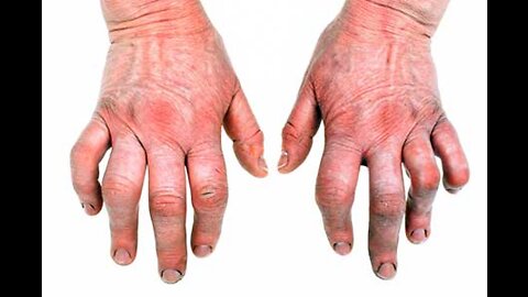 How to Preventing Arthritis. Learn about 5 Ways to Manage Arthritis