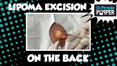 Lipoma excision, Upper Back