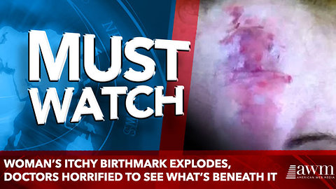 Woman’s Itchy Birthmark Explodes, Doctors Horrified To See What’s Beneath It