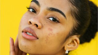 Ten Common Acne Myths and Why They Aren’t True