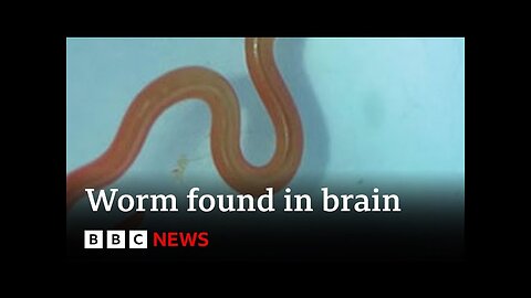 Live worm found in Australian woman's brain - BBC News