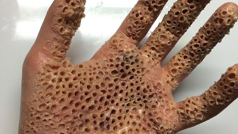 Hand Riddled With Tiny Holes Reveals A Mysterious Phobia