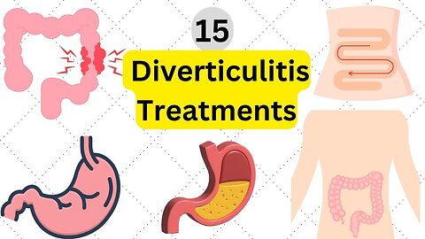 15 Diverticulitis treatments