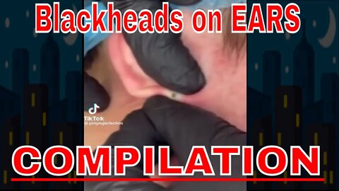 Blackheads on EARS COMPILATION! 🪱 #blackheadremoval #blackhead #blackheadremove #satisfying #fypage