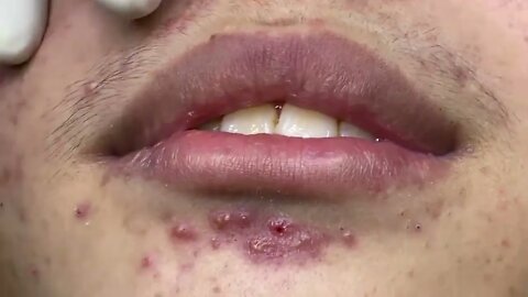 Remoção de cravos e espinhas. Vídeo maravilhoso de se ver, simplesmente satisfatório !!! Blackhead