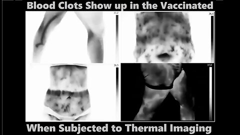 Blood Clots Show Up Under Thermal Imaging