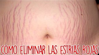 Como Eliminar Las Estrias Rojas