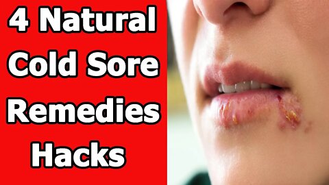 4 Natural Cold Sore Remedies