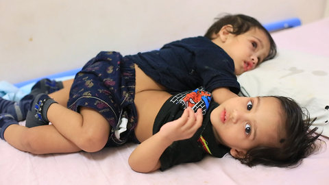 The Conjoined Twin Brothers Who Survived Separation | BORN DIFFERENT