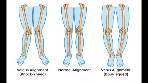 How To Straighten Your Legs Without the Surgery