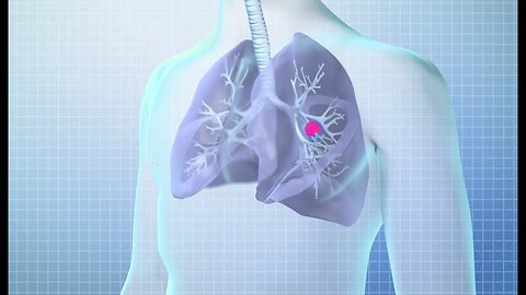 Prueba de detección de cáncer de pulmón