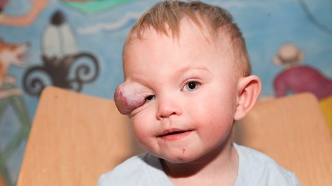 Brave Toddler Has Sight-Saving Surgery On Tumour