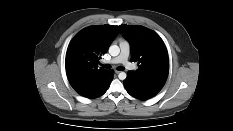 Anatomy of CT scans: Thoracic cavity