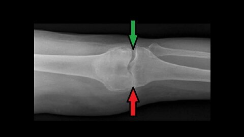 Tinnitus And Bone On Bone Knee Arthritis Dr Joel Wallach