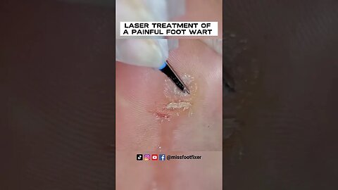 LASER TREATMENT OF A PAINFUL FOOT WART / VERRUCA [2023] BY FAMOUS FEETT SPECIALIST MISS FOOT FIXER