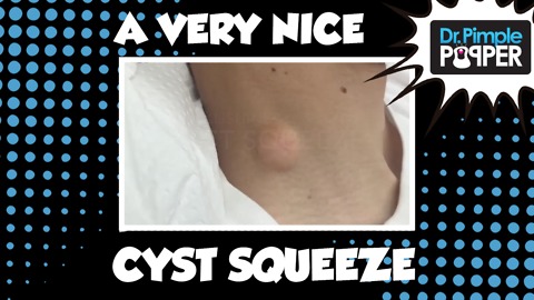It's Tough to have a Cyst on a Ticklish Neck!