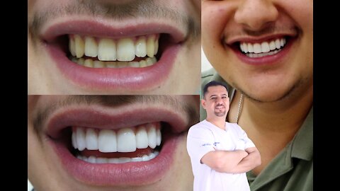 3D Veneers