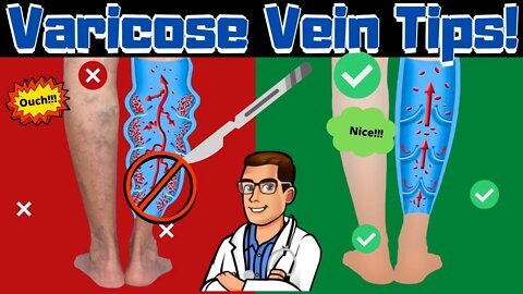 BEST Varicose Vein Home Treatments! [Top 25 Spider Veins Remedies]