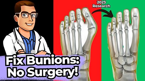 TOP 13 Ways to Shrink Bunions Naturally [+1 HUGE SECRET!]