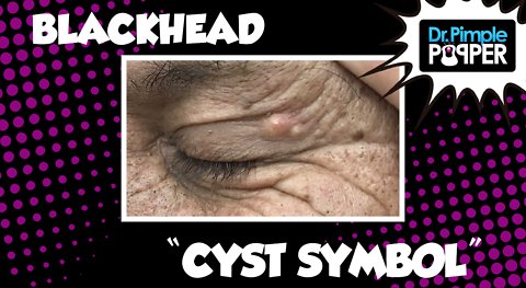 A Blackhead "Cyst Symbol"