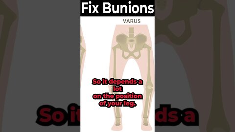 What Causes Bunions on Feet FOR REAL? [What are Bunions? REALLY?]