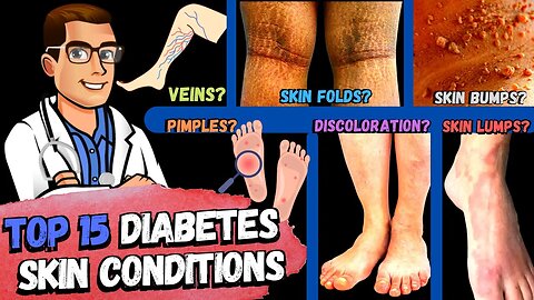 TOP 15 Diabetes Skin Signs & Symptoms [Type 2 & 1 Diabetes Mellitus]