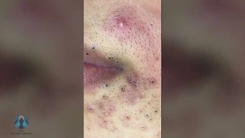 cravos pretos nos lábios!! Satisfatório Vídeo Espremendo cravos e espinhas Blackhead