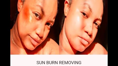 Sunburn Removal