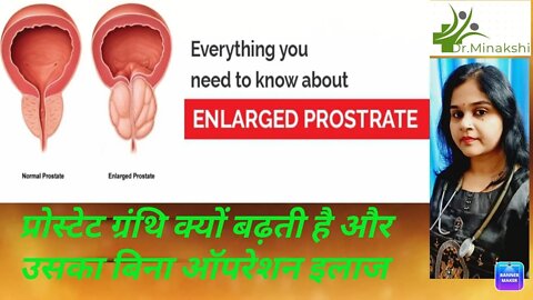 Prostate gland enlargement | प्रोस्टेट ग्रंथि का बढ़ना कारण और उपचार #homeopathy #प्रोस्टेट
