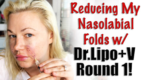 Reduce your Nasolabial folds with Dr.Lipo+V from www.acecosm.com | Code Jessica10 Saves you Money!