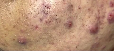 Big Cystic Acne Blackheads Extraction Blackheads & Milia, Whiteheads Removal Pimple Popping