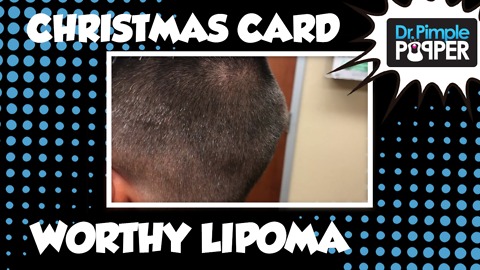 A Christmas Card Worthy Lipoma