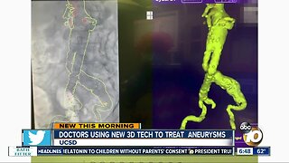 3D technology helping doctors treat aneurysms