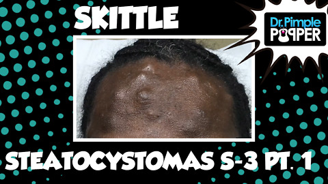 Skittle Steatocystoma Session Three, Part One