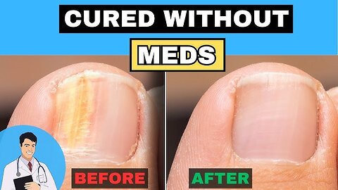 Nail Fungus Unveiled: Causes, Symptoms, and Natural Treatments