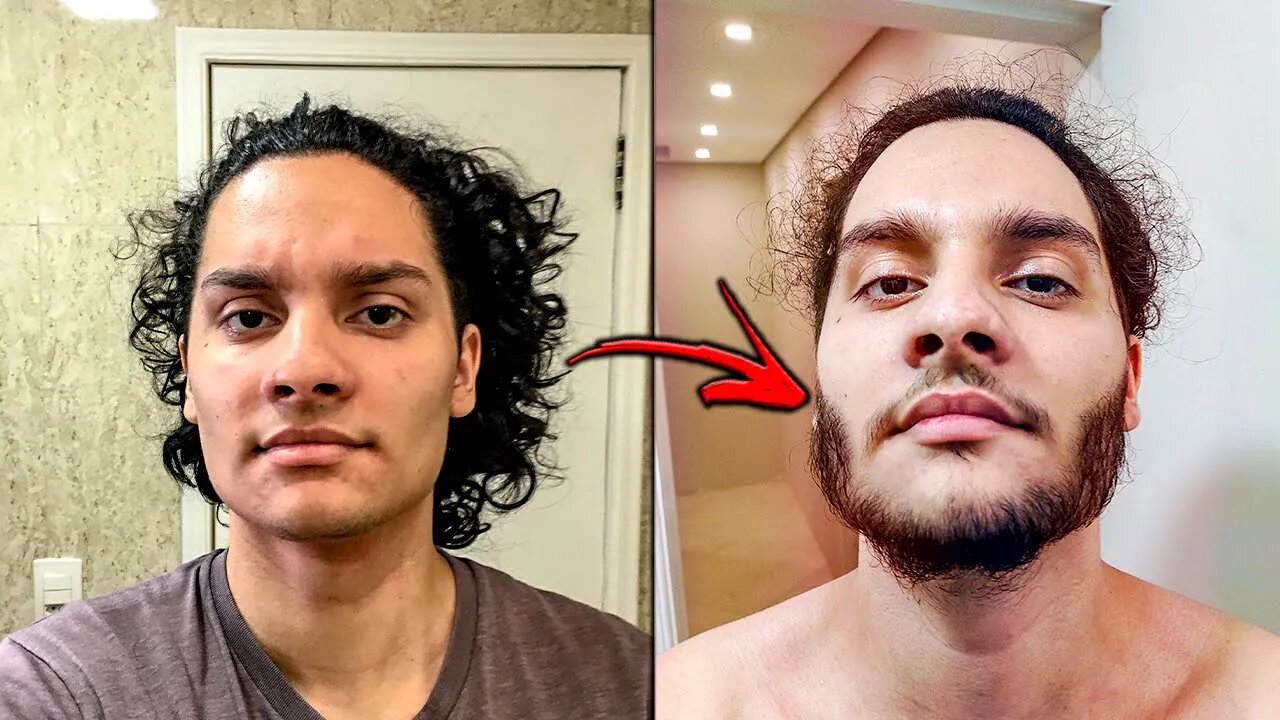 EVOLU O MINOXIDIL ANTES X DEPOIS EVOLU O 1 FOTO POR DIA