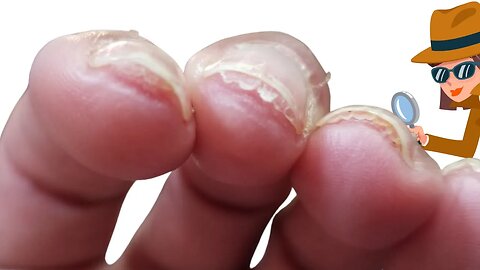 Why is the nail separating from nail bed? [Nail bed hyperkeratosis?]