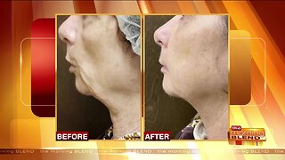 Non-Surgical Face Lifts Making 50 the New 30!